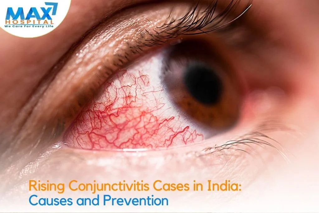 Rising Conjunctivitis Cases in India: Causes and Prevention